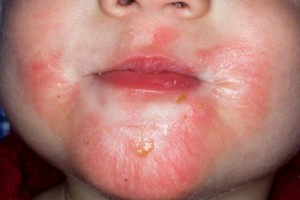 dermatit