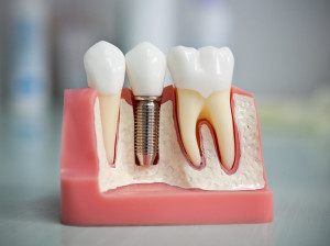 implantaciy