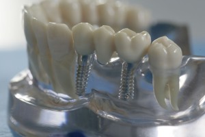 implantaciya