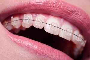 macro shot on woman mouth with braces on her teeth, low angle view, big smile, dentist concept.