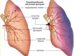 Лечение тромбоэмболии легочной артерии