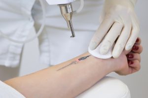 Преимущества и недостатки удаления татуировок с помощью неодимового лазера
