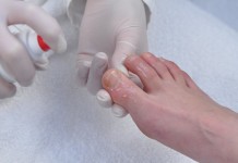 Онихолизис: методы лечения