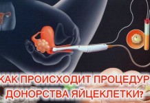 Как происходит процедура донорства яйцеклетки