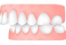Исправление прикуса: современные методы коррекции