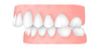 Исправление прикуса: современные методы коррекции