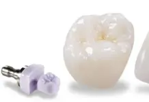 Все, что вы хотели знать о коронке вкладки E-max: идеальное решение для вашего улыбки